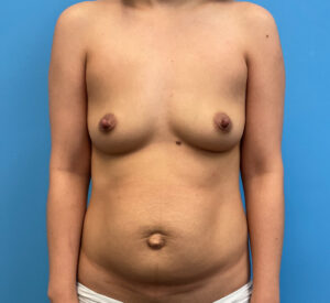 Breast-Augmentation-Case--4098 | Before Breast Augmentation 1