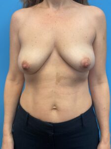 Breast-Reconstruction-Case--6069 | Before Dr. Frank Albino 1
