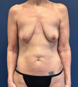 Augmentation-Mastopexy-Case--7491 | Before Breast Augmentation With Lift 1