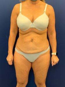 Abdominoplasty-Case--7924 | Before Tummy Tuck 1