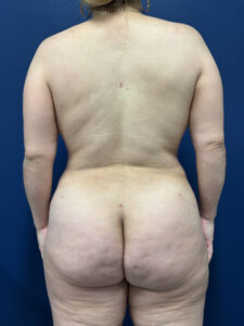 Brazilian-Butt-Lift-Case--9569 | After Brazilian Butt Lift 1