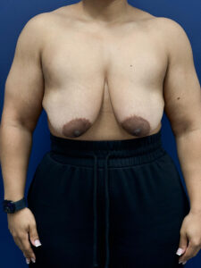 Breast-Reduction-Case--7345 | Before Dr. Frank Albino 1