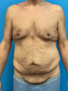 Abdominoplasty-Case--2524 | Before Tummy Tuck 1