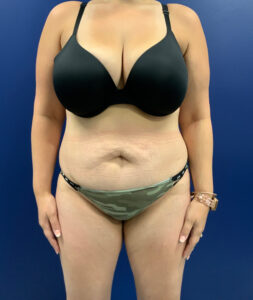 Abdominoplasty-Case--3073 | Before Tummy Tuck 1