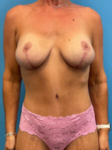 Abdominoplasty-Case--7009 | After Dr. Frank Albino 1