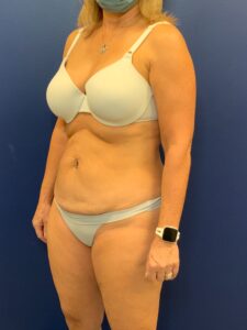 Abdominoplasty-Case--7924 | Before Tummy Tuck 2