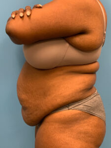 Abdominoplasty-Case--5907 | Before Dr. Frank Albino 2