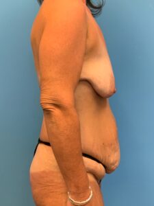 Abdominoplasty-Case--7009 | Before Dr. Frank Albino 2