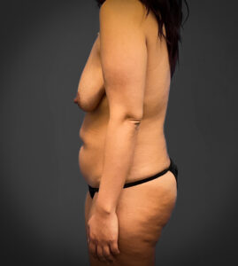 Augmentation-Mastopexy-Case--2371 | Before Breast Lift 2