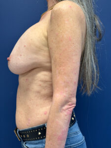 Breast-Reconstruction-Case--8978 | Before Dr. Frank Albino 2