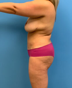 Abdominoplasty-Case--3073 | After Tummy Tuck 2
