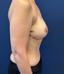 Abdominoplasty-Case--4660 | After Body 2