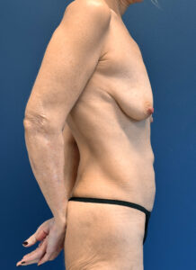 Augmentation-Mastopexy-Case--7491 | Before Breast Augmentation With Lift 2