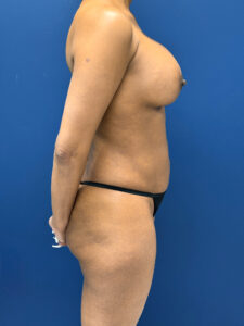 Lipo-360-Case--8130 | After Liposuction 2