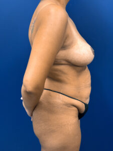 Breast-Reduction-Case--4484 | After Breast Reduction 2