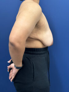 Breast-Reduction-Case--7345 | After Dr. Frank Albino 1